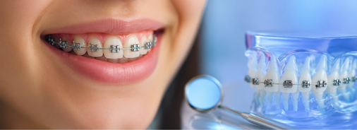 Braces