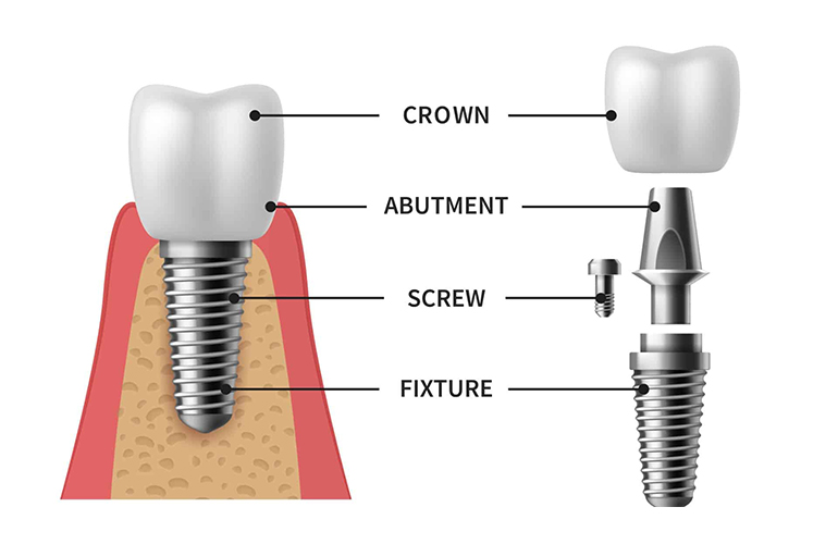 dental implant center vizag