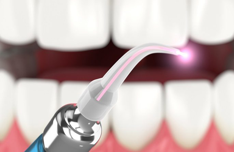 dental laser treatment